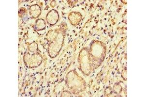 Immunohistochemistry of paraffin-embedded human gastric cancer using ABIN7166087 at dilution of 1:100 (S1G (AA 1-66) anticorps)