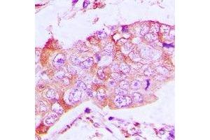 Immunohistochemical analysis of CapG staining in human lung cancer formalin fixed paraffin embedded tissue section. (CAPG anticorps)