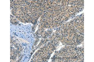 Immunohistochemistry of Human liver cancer using CRLF2 Polyclonal Antibody at dilution of 1:60