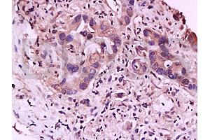 Formalin-fixed and paraffin embedded human gastric carcinoma labeled with Anti-IL-23R Polyclonal Antibody, Unconjugated (ABIN686857) at 1:200 followed by conjugation to the secondary antibody and DAB staining