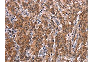The image on the left is immunohistochemistry of paraffin-embedded Human gastic cancer tissue using ABIN7190640(FDCSP Antibody) at dilution 1/25, on the right is treated with synthetic peptide. (FDCSP anticorps)