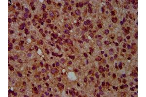 IHC image of ABIN7154699 diluted at 1:500 and staining in paraffin-embedded human glioma performed on a Leica BondTM system. (GNAL anticorps  (AA 4-116))