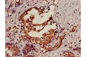 Immunohistochemistry of paraffin-embedded human breast cancer using ABIN7168837 at dilution of 1:100 (SENP2 anticorps  (AA 138-324))
