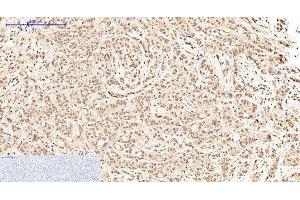 Immunohistochemistry of paraffin-embedded Human breast cancer tissue using Oct-1/2 Monoclonal Antibody at dilution of 1:200. (Oct-1/2 anticorps)