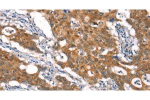 Immunohistochemistry of paraffin-embedded Human gasrtic cancer tissue using CYLD Polyclonal Antibody at dilution 1:35 (CYLD anticorps)