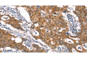 Immunohistochemistry of paraffin-embedded Human gasrtic cancer tissue using CYLD Polyclonal Antibody at dilution 1:35