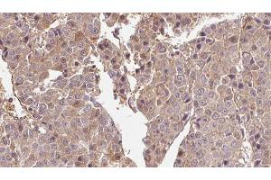 ABIN6274569 at 1/100 staining Human liver cancer tissue by IHC-P. (5HT1B Receptor anticorps  (Internal Region))