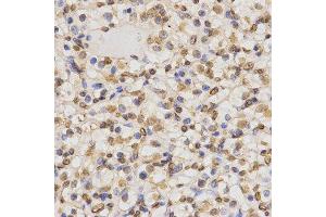 Immunohistochemistry of paraffin-embedded human kidney cancer using DiMethyl-Histone H3-K36 antibody.
