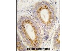 Forlin-fixed and paraffin-embedded hun colon carcino tissue reacted with RS2 antibody (C-term) (ABIN392309 and ABIN2841960) , which was peroxidase-conjugated to the secondary antibody, followed by DAB staining. (MARS anticorps  (C-Term))