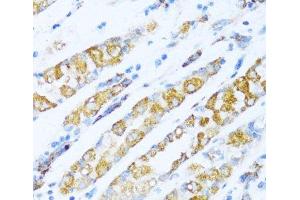 Immunohistochemistry of paraffin-embedded Human gastric cancer using NDUFA5 Polyclonal Antibody at dilution of 1:100 (40x lens). (NDUFA5 anticorps)