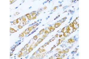 Immunohistochemistry of paraffin-embedded Human gastric cancer using NDUFA5 Polyclonal Antibody at dilution of 1:100 (40x lens). (NDUFA5 anticorps)