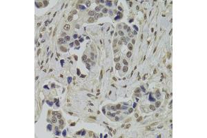 Immunohistochemistry of paraffin-embedded human breast cancer using INTS6 Antibody (ABIN2563455) at dilution of 1:100 (40x lens). (INTS6 anticorps)