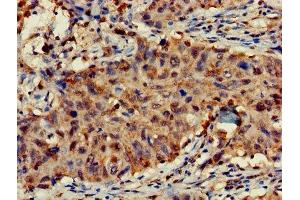 Immunohistochemistry of paraffin-embedded human lung cancer using ABIN7143032 at dilution of 1:100 (FAM17A (AA 1-144) anticorps)