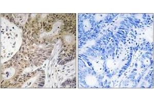 Immunohistochemistry analysis of paraffin-embedded human colon carcinoma tissue, using PRPF6 Antibody. (PRP6/ANT-1 anticorps  (AA 747-796))