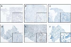CTSL expression in normal and tumor tissues of the lung and breast.