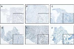 CTSL expression in normal and tumor tissues of the lung and breast. (Cathepsin L anticorps  (AA 114-288))