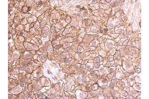 IHC-P Image E-cadherin antibody detects E-cadherin protein at membrane on human breast cancer by immunohistochemical analysis.