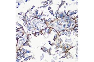 Immunohistochemistry of paraffin-embedded human lung cancer using MMP16 antibody (ABIN6132356, ABIN6143906, ABIN6143907 and ABIN6214654) at dilution of 1:100 (40x lens). (MMP16 anticorps  (AA 290-565))