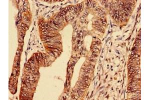 Immunocytochemistry analysis of human colon cancer using ABIN7172795 at dilution of 1:100