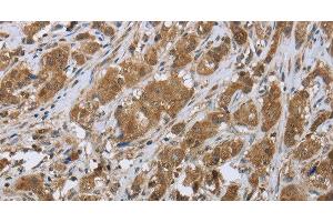 Immunohistochemistry of paraffin-embedded Human breast cancer tissue using CLPS Polyclonal Antibody at dilution 1:45 (CLPS anticorps)