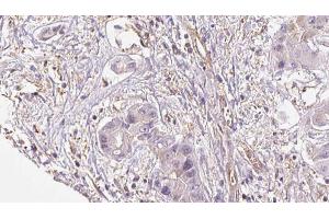 ABIN6273953 at 1/100 staining Human liver cancer tissue by IHC-P. (NPY4R anticorps  (N-Term))