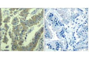 Immunohistochemical analysis of paraffin-embedded human lung carcinoma tissue using MARCKS (phospho-Ser170) Antibody (E011535). (MARCKS anticorps  (pSer170))