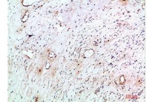 Immunohistochemical analysis of paraffin-embedded human-cervical-cancer, antibody was diluted at 1:200