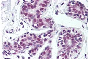Human Breast (formalin-fixed, paraffin-embedded) stained with TARDBP antibody ABIN307182 at 5 ug/ml followed by biotinylated goat anti-rabbit IgG secondary antibody ABIN481713, alkaline phosphatase-streptavidin and chromogen. (TARDBP anticorps  (Internal Region))