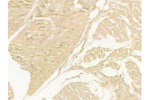 ABIN6262540 and ABIN6278895 at 1/100 staining human tongue carcinoma by IHC-P. (IL17F anticorps  (Internal Region))