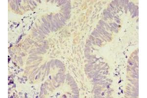 Immunohistochemistry of paraffin-embedded human ovarian cancer using ABIN7165911 at dilution of 1:100