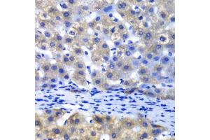 Immunohistochemistry of paraffin-embedded human liver injury using PSMD8 antibody. (PSMD8 anticorps)