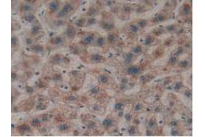 IHC-P analysis of Human Liver Cancer Tissue, with DAB staining. (LGALS8 anticorps  (AA 1-317))
