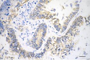 Immunohistochemistry was performed on paraffin-embedded human sigmoid colon carcinoma using catenin beta 1 antibody (ABIN7797929), 1:100).