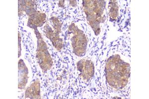 IHC testing of FFPE human breast cancer with SMN1/2 antibody. (SMN1 / SMN2 anticorps)
