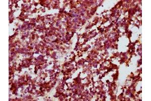 IHC image of ABIN7127685 diluted at 1:100 and staining in paraffin-embedded human lung cancer performed on a Leica BondTM system. (Recombinant CREB1 anticorps  (pSer133))