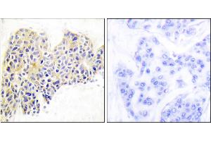Immunohistochemical analysis of paraffin-embedded human breast carcinoma tissue using HSP90B (Ab-254) antibody.