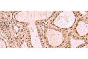 Immunohistochemistry of paraffin-embedded Human thyroid cancer tissue using KDM7A Polyclonal Antibody at dilution of 1:35(x200) (JHDM1D anticorps)