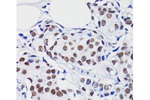 Immunohistochemistry of paraffin-embedded Human breast cancer using Acetyl-Histone H2B-K15 Polyclonal Antibody at dilution of 1:100 (40x lens).