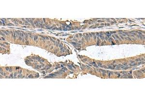 Immunohistochemistry of paraffin-embedded Human colorectal cancer tissue using ZG16 Polyclonal Antibody at dilution of 1:95(x200)
