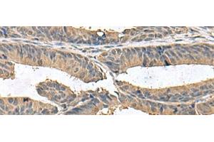 Immunohistochemistry of paraffin-embedded Human colorectal cancer tissue using ZG16 Polyclonal Antibody at dilution of 1:95(x200) (ZG16 anticorps)