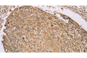 Immunohistochemistry of paraffin-embedded Human lung cancer tissue using RNF148 Polyclonal Antibody at dilution 1:45 (RNF148 anticorps)