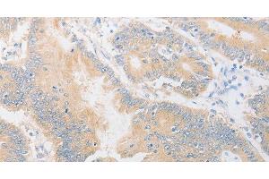 Immunohistochemistry of paraffin-embedded Human colon cancer using CD24 Polyclonal Antibody at dilution of 1:40 (CD24 anticorps)