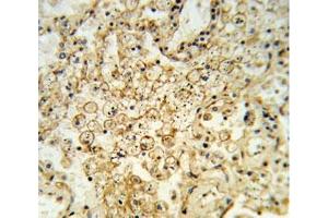 IHC analysis of FFPE human lung carcinoma stained with HLA-G antibody