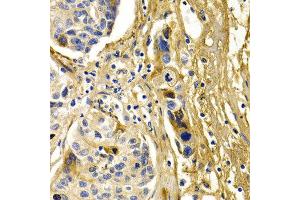 Immunohistochemistry of paraffin-embedded human liver cancer using CFH antibody at dilution of 1:200 (400x lens). (Complement Factor H anticorps)