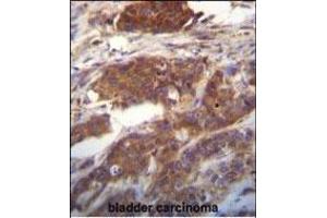 Ufc1 Antibody (C-term) (ABIN650703 and ABIN2839221) immunohistochemistry analysis in formalin fixed and paraffin embedded human bladder carcinoma followed by peroxidase conjugation of the secondary antibody and DAB staining. (UFC1 anticorps  (C-Term))