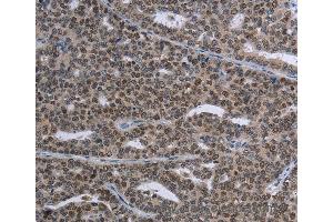 Immunohistochemistry of Human thyroid cancer using MAGEC1 Polyclonal Antibody at dilution of 1:30 (MAGEC1 anticorps)
