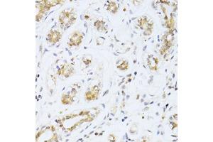 Immunohistochemistry of paraffin-embedded human breast cancer using ETV1 antibody (ABIN6291698) at dilution of 1:100 (40x lens). (ETV1 anticorps)