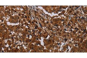 Immunohistochemistry of paraffin-embedded Human liver cancer tissue using MAGEB18 Polyclonal Antibody at dilution 1:30
