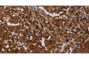 Immunohistochemistry of paraffin-embedded Human liver cancer tissue using MAGEB18 Polyclonal Antibody at dilution 1:30 (MAGEB18 anticorps)