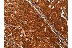The image on the left is immunohistochemistry of paraffin-embedded Human gastric cancer tissue using ABIN7190469(DHH Antibody) at dilution 1/25, on the right is treated with synthetic peptide. (desert Hedgehog anticorps)